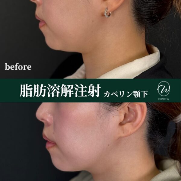 脂肪溶解注射(カベリン)