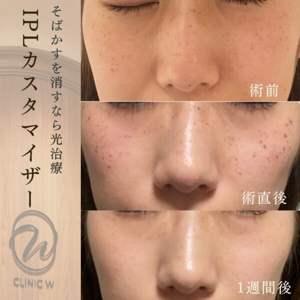 IPL(光治療・フォト)カスタマイザー | 高崎駅徒歩5分(群馬県高崎市) | CLINIC W