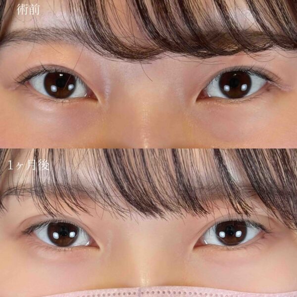 二重埋没法(自然癒着法)
