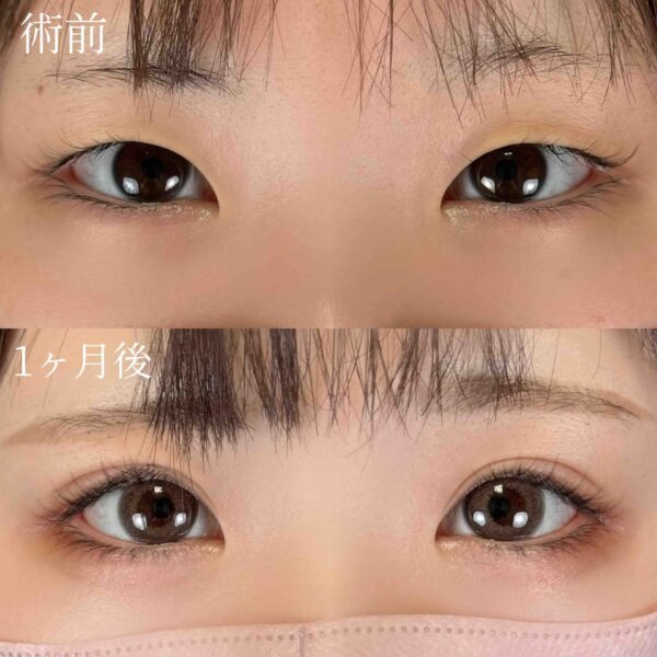 二重埋没法（自然癒着法）
