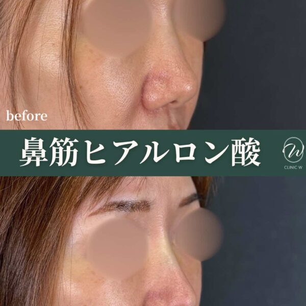 鼻筋ヒアルロン酸