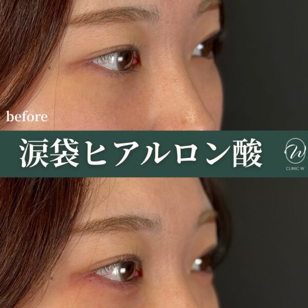 涙袋ヒアルロン酸
