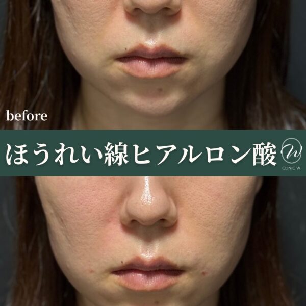 ほうれい線ヒアルロン酸