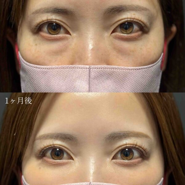 目の下のクマ治療