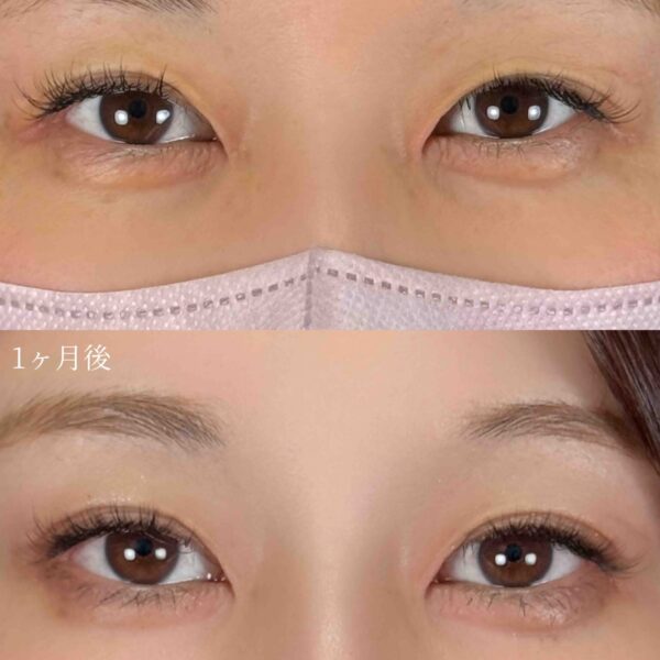 二重埋没法(自然癒着法)