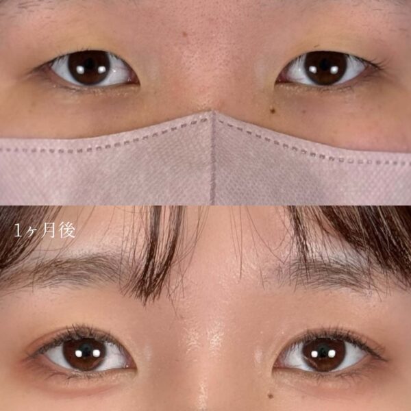 二重埋没法(自然癒着法)