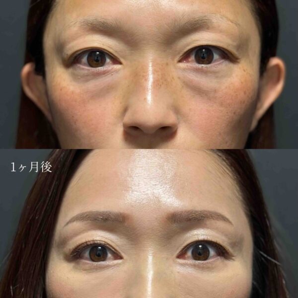 目の下のクマ治療