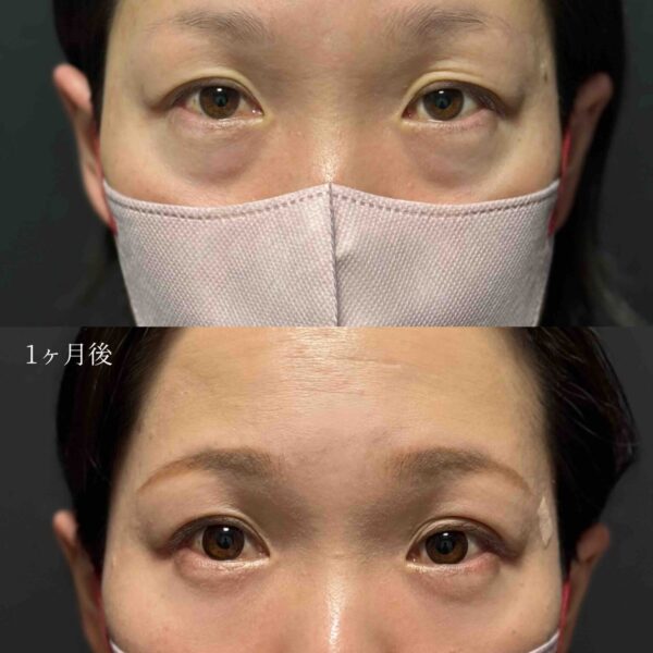 目の下のクマ治療