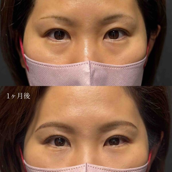 目の下のクマ治療