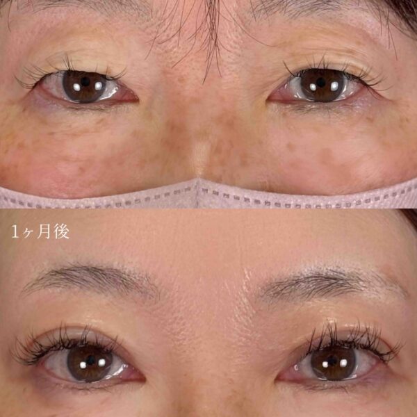 二重埋没法(自然癒着法)