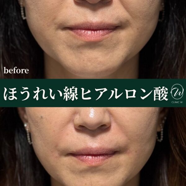 ほうれい線ヒアルロン酸