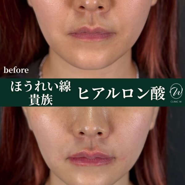貴族・ほうれいせんヒアルロン酸