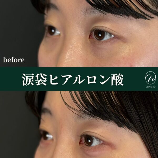 涙袋ヒアルロン酸