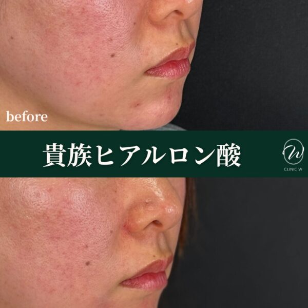 貴族ヒアルロン酸