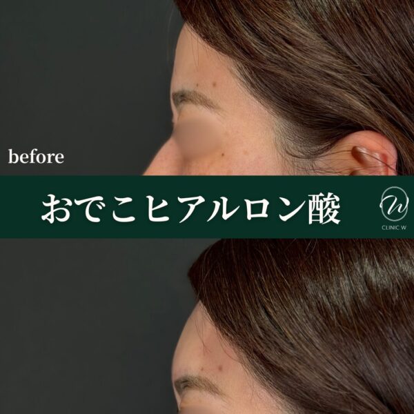 おでこヒアルロン酸