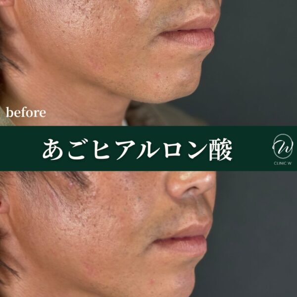 あごヒアルロン酸
