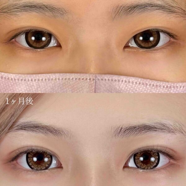 二重埋没法（自然癒着法）