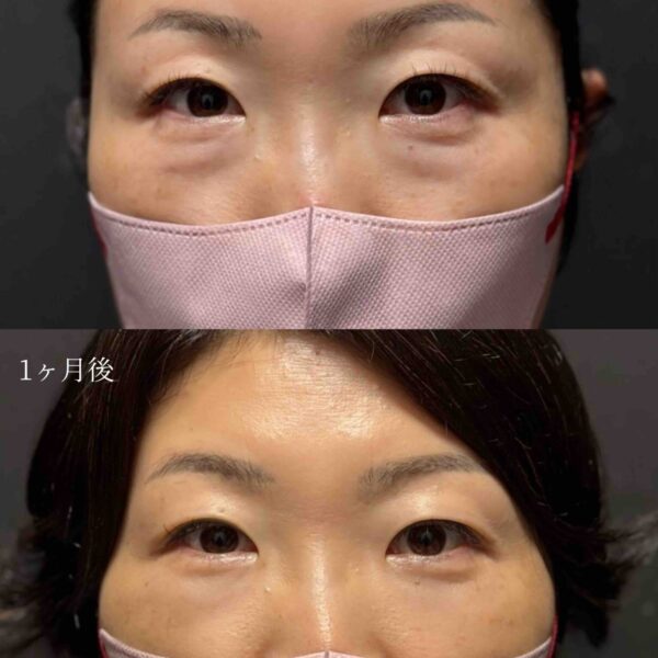 目の下のクマ治療