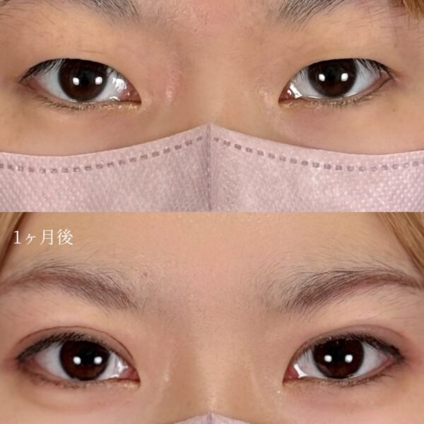 二重埋没法（自然癒着法）