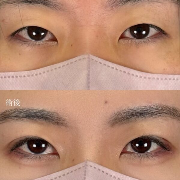 二重埋没法（自然癒着法）