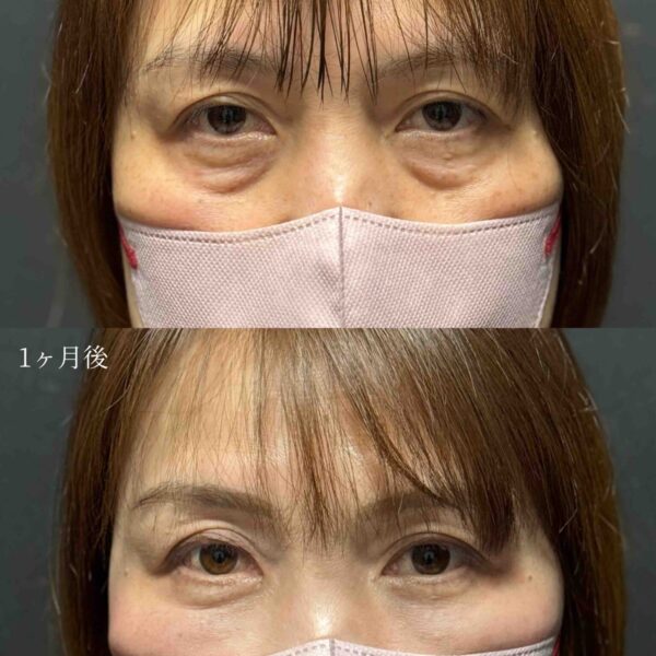 目の下のクマ治療