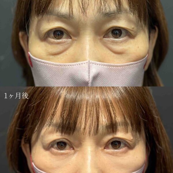 目の下のクマ治療