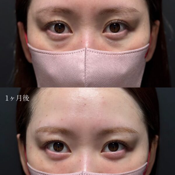 目の下のクマ治療