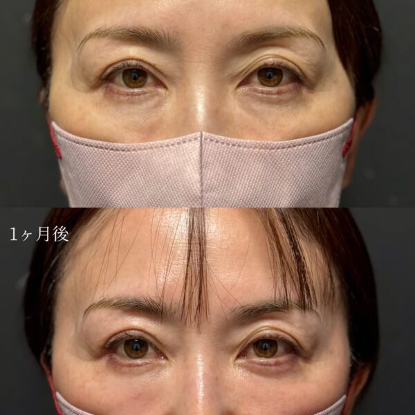 目の下のクマ治療