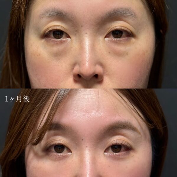 目の下のクマ治療