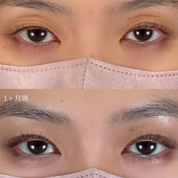 二重埋没法(自然癒着法)