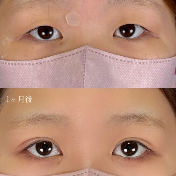 二重埋没法（自然癒着法）＆目頭切開