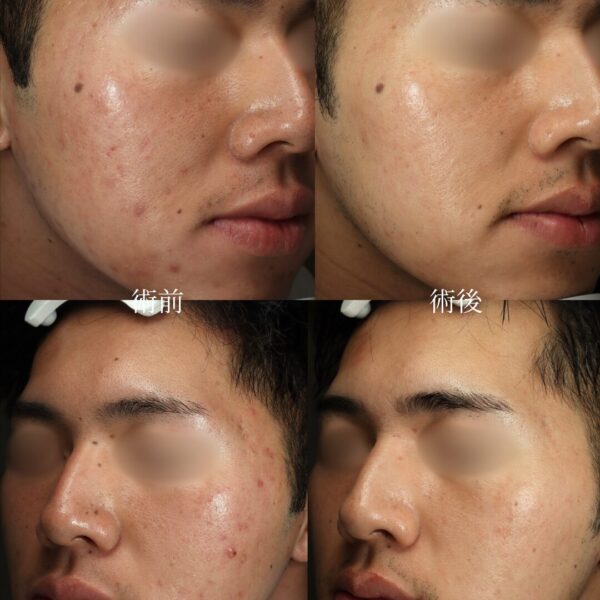 サーマニードル