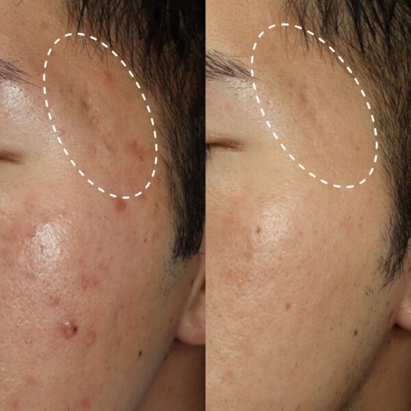 サーマニードル