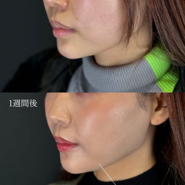 ショッピングリフト（ショートスレッド）