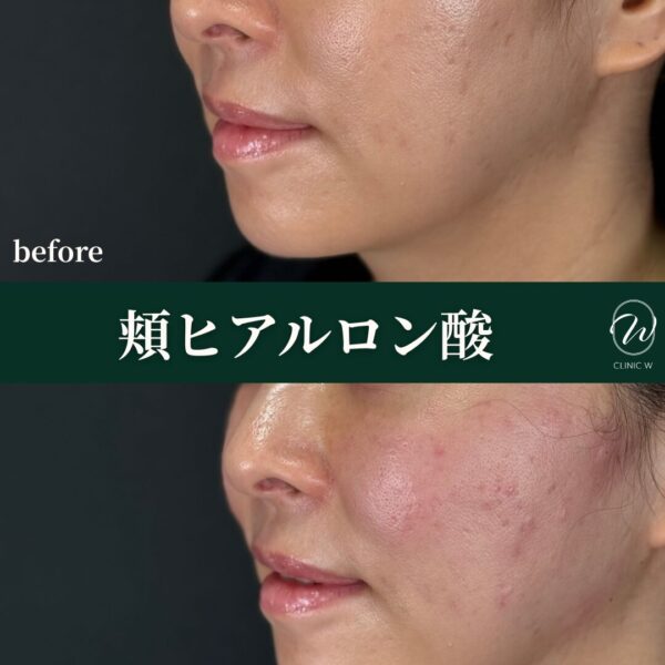 頬ヒアルロン酸
