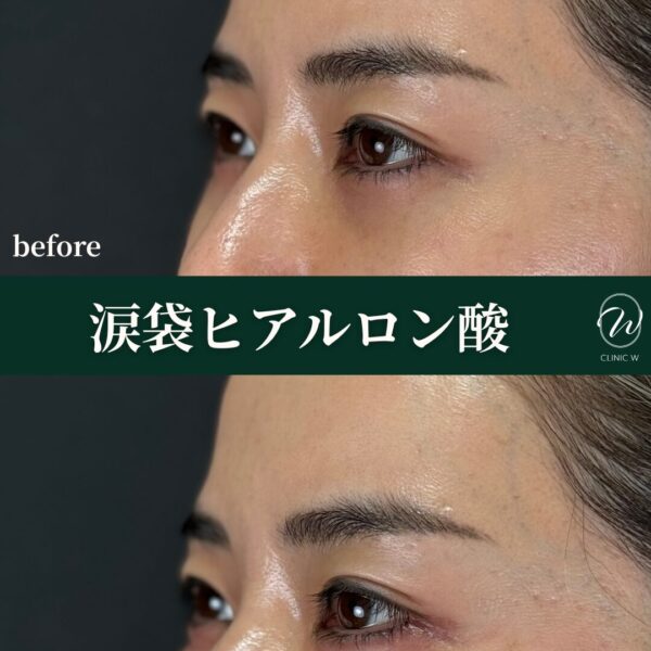 涙袋ヒアルロン酸