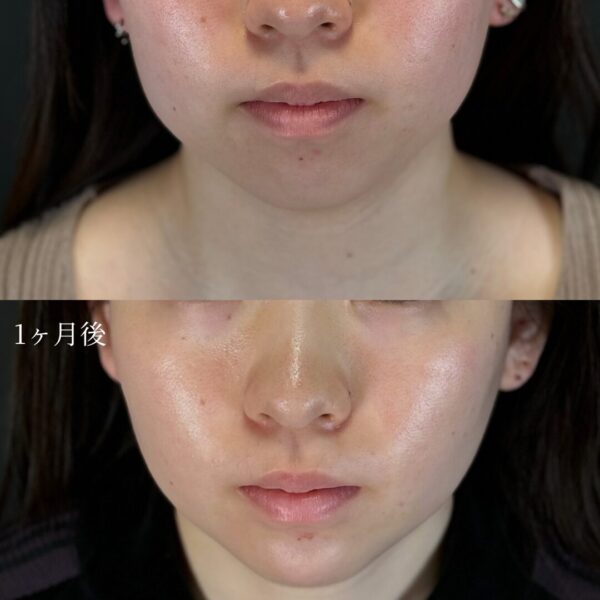 バッカルファット除去