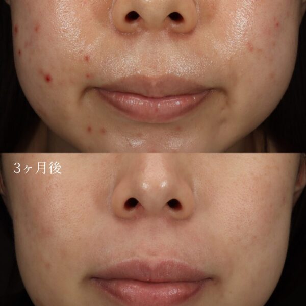 イソトレチノイン（3ヶ月服用）