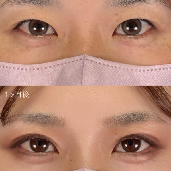 二重埋没法（自然癒着法）