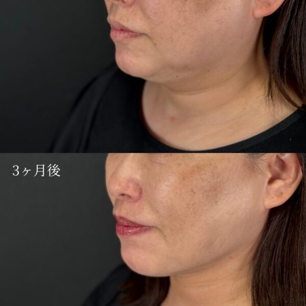 顔の脂肪吸引（フェイスライン・顎下）