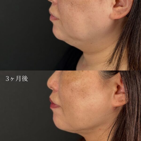 顔の脂肪吸引（フェイスライン・顎下）