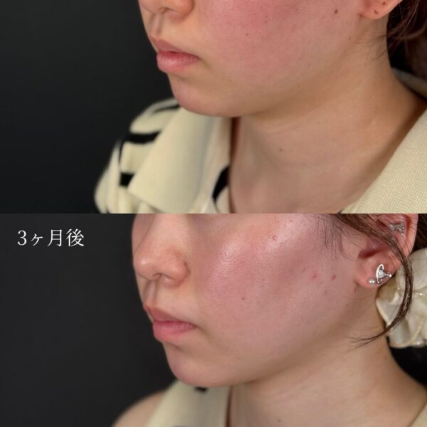 顔の脂肪吸引（フェイスライン・顎下）