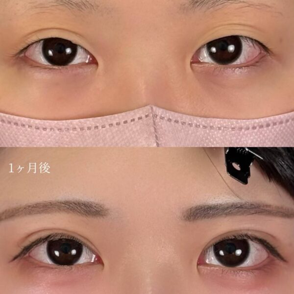 二重埋没法（自然癒着法）