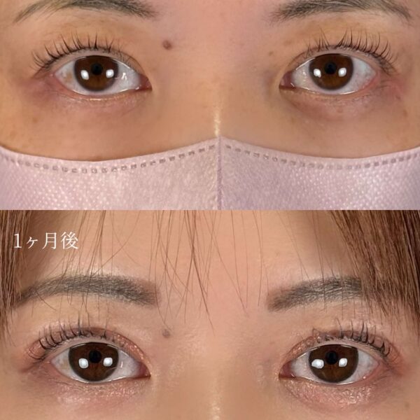 二重埋没法（自然癒着法）