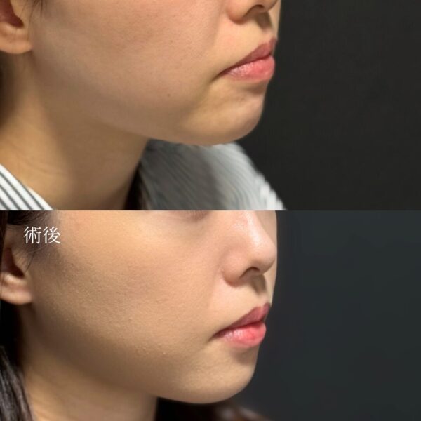 ジョールファット除去