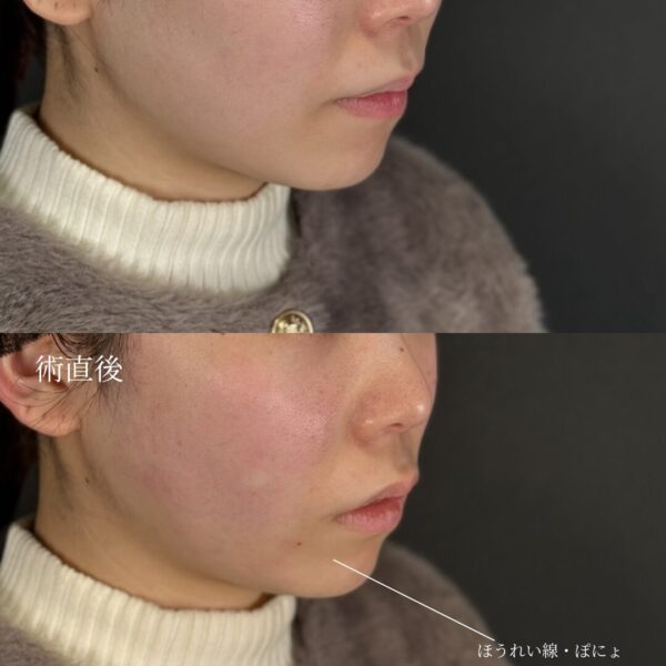 糸リフト（W式リフト）