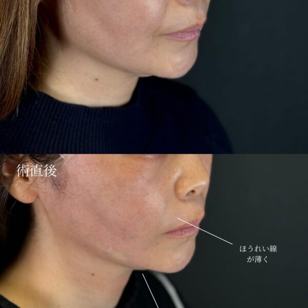 糸リフト（W式リフト）