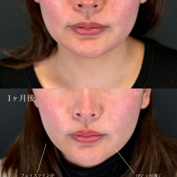 糸リフト（W式リフト）