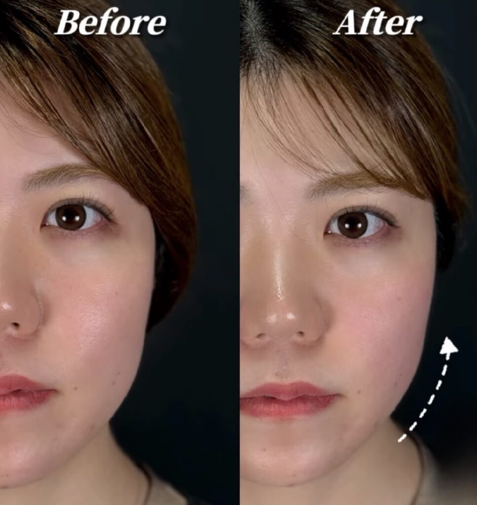 CLINIC W オンダリフト｜ONDA PRO 症例紹介 正面｜ほほ＋あご下、1回照射、施術前→直後