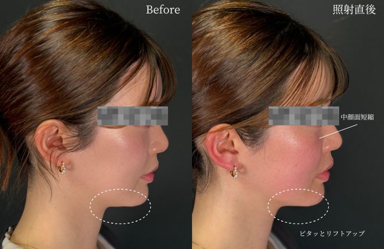 CLINIC W オンダリフト｜ONDA PRO 症例紹介 横顔｜ほほ＋あご下、1回照射、施術前→直後